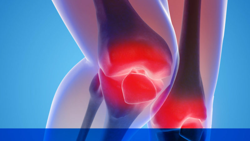 Chronic Osteoarthritis Hijama Pain Relief